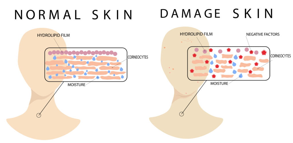 dry skin, snowperkid, snowperk, skin barrier, sensitive skin