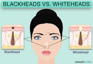 The difference between blackheads and whiteheads